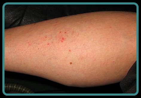 Sea lice: How to avoid them, and how to treat the stings ...