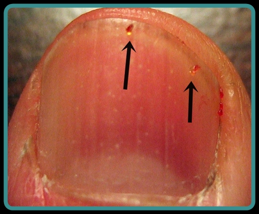 Bird Mites Life Cycle