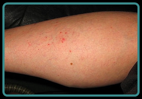 sea lice rash treatment - pictures, photos